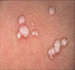- a palpable, elevated, circumscribed, solid mass
- caused by superficial thickening in the epidermis 
- up to 1.0 cm 
example: elevated nevus, lichen planus, wart, molluscum, bug bite