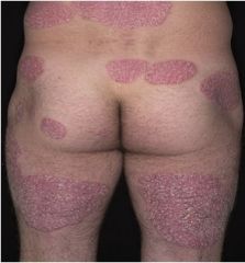 - common chronic inflammatory papulosquamos disease of unknown etiology 
- common presentation is red, sharply defined, scaly papules that coalesce to form stable round to oval plaques 
- scale is adherent, silvery, white 
- may have nail and or j...