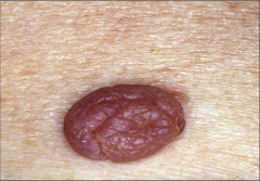 - a solid, elevated, firm or soft mass less than 1-2 cm 
- may be firmer and extend deeper into the dermis than a papule 
example: fibroma, intradermal nevi