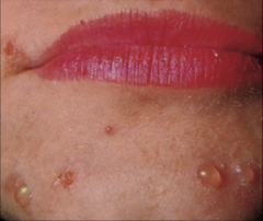 - a circumscribed, superficial, elevated cavity 
- contains free fluid
- clear fluid flows if wall ruptured 
- up to 1 cm in size 
example: herpes simplex, chicken pox, contact dermatitis, herpes zoster