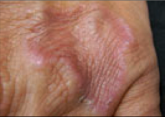 chronic inflammation, usually in response to infection 