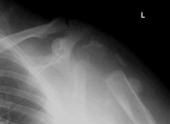 Hx:50 WC-bound M w/ a hx of traumatic SCI presents w/ 6 mths of progressive, PE-painless L shoulder weakness, decreased range of motion, afebrile and CBC, ESR, and C-rxt prtn levels are nl. xray Fig A. Early management should include:1-HIV testing...