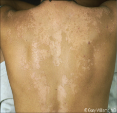  


caused by yeasted called malassezia 


- numerous small, circular, white, scaling papules on the upper trunk 


- may involve the upper arms, neck and abdomen


- lesions are hypopigmented in tanned skin and pink or salmon colored i...