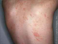 often confused with syphilis  


- usually occurs b/w


the ages of 10-30 


- self limited rash that is preceded by a "herald patch" 


- differential dx: secondary syphilis due to similar truncal presentation, age, papulosquamous lesi...