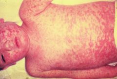 Measles : 
     Fever 
    -Conjunctivitis
     Rash