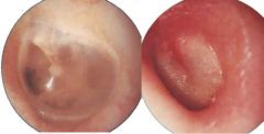 Disease:

Otitis media
[Image: normal vs inflamed]