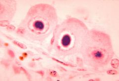 Cytomegalovirus (CMV)

[Infected cells display characteristic "owl eye" intranuclear viral inclusions - image]