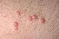 Molluscum contagiosum

[These lesions caused by the pox virus occur as clusters on the trunk, genitalia, and extremities; it is transmitted by towels, barbers, swimming pools, and sexual activity]