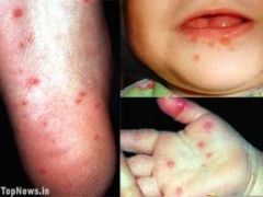 Coxsakievirus

[Discrete vesicles on the throat and tongue with pain and difficulty swallowing]

Hand foot and mouth [image]