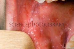 Measles virus

[The presence of Koplik spots, small bluish-white ulcerations on the oral mucosa, are pathognomonic]