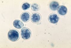 Blastomyces dermatitidis

[Fungi appears in infected tissue as yeast with broad-based budding]