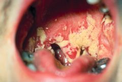 Fungi:

Causes white curd-like patches on mucocutaneous membranes of the mouth and extend downward to cause esophagitis in immunocompromised patients