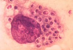 Histoplasma capsulatum

[Histologically characterized by macrophages stuffed with numerous yeast cells - image]