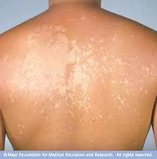 Fungi:

Causes tinea versicolor, which manifests as patches of hyper- and hypopigmentation on the trunk