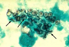 Pneumocystis (carinii) jirovecii

[Previously thought to be a protozoa, this fungus causes a foamy, amorphous alveolar exudate and is seen as cup- or boat-shaped cysts upon staining with silver methenamine]