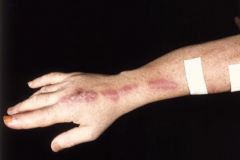 Sporothrix schenckii

[Transmitted by the prick of a contaminated thorn; treated with a dilute solution of potassium iodide (KI) in milk]

Can spread via lymphatics and lead to lymphocutaneous sporotrichosis [image]