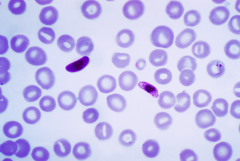 Plasmodium spp.

[An obligate intracellular parasite, Plasmodium is typically seen as ring- or crescent-shaped forms within RBCs on a Giemsa-stained peripheral blood smear]