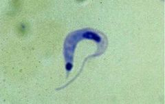 Trypanosoma cruzi

[Transmitted by the droppings of the reduviid bug ("kissing bug"), often with the initial development of unilateral swelling of the eyelids (Romana's sign)]
