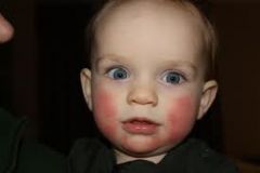 DNA Viruses:

Infection of a child results in a "slapped cheek" appearance