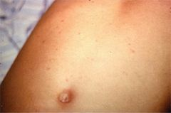 Gram Negative:

Causes an enteric fever with the development of characteristic "rose spots" on the abdomen