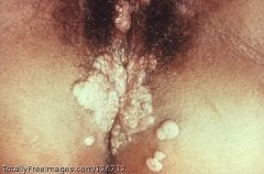 Treponema pallidum

[Secondary syphilis presents with a rash and gray flattened wart-like lesions on the anogenital, axillary, and oral areas; these condyloma lata - image - are not to be confused with condyloma acuminatum seen with HPV infection]