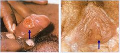 Poorly Staining:

Initial infection presents with a painless ulcer on the genitals known as a chancre
