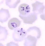 Babesia microti

[Often mistaken for P. falciparum, the organism can be detected in RBCs as a "Maltese cross," which is diagnostic]