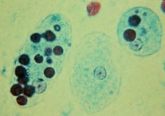 Entamoeba histolytica

[The finding of trophozoites with ingested RBCs is pathognomonic]