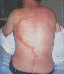 -Transient characteristic mark in lightning injury
-Fern-like pattern
-Red mark on skin of unknown cause
-Usually appears after one hour and disappears after 24 hours