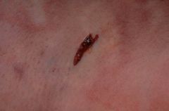 -Larger, more irregular than entrance wounds:
-No abrasion collar
        -Stellate
        -slit-like
        -shored (may cause confusion with entrance wound)