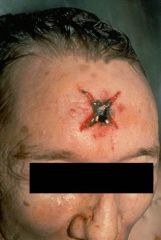 -Entrance wound often stellate
-Bevelling of cranial bone allow for differentiation between entrance/exit wound
-"Keyhole" gunshot wound