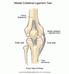 Thickening of the fibrous capsule on the medial side of the knee.

Provides medial support to the knee.