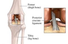 Located within the knee joint.

Runs from tibia upward, forward and medial to attach to the lateral side of the medial condyle of the femur.

Prevents posterior displacement of the tibia on the femur. Prevents hyperflexion of the knee joint.