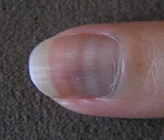 Triad: H/O severe GI illness, rash & peripheral neuropathy.
See Mees' lines on nails
Painful sensorimotor neuropathy
Hyperkeratosis of palms and soles