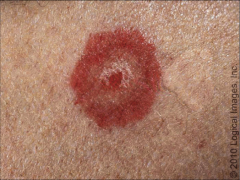  


- acute, immune - mediated condition 


- distinctive target-like lesions


- multiforme, describes the myriad clinical manifestation that may be observed


- target lesions: dusky central area or blister, dark red inflammatory zone,...