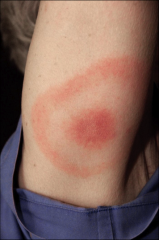 80% lyme disease


tick bite, bullseye


well demarkated line 


any place with increased exposure to lyme you just treat with lyme 


doesn't have to be where the person was bitten