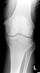 presence of an ACL tear does NOT preclude nonop tx. Timing of ACL recon w/ a concomitant MCL sprain should be delayed proportional to the extent of MCL damage. (Grade I inj, 3-4 wks; grade II inj, 4-6 wks; grade III inj, 6-8 wks.) recom nonop mana...