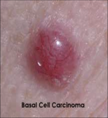 - most common type of skin cancer


- locally invasive, aggressive destructive lesion


- rises from the basal layer of the epidermis 


- limited capacity to metastasize 


remove it 