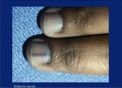 can occur with dark skin or r/t subangula melanoma 