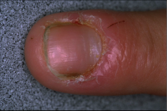 - acute: bacterial infection of the proximal and laternal nail fold


- rapid onset of pain and swelling


- pus accumulates behind cuticle


- chronic irritant exposure 


topical antibiotic