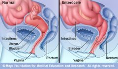herniation of the peritoneal sac between the vagina and the rectum. Unlike other types of pelvic organ prolapse,enterocele is a true herniation with a peritoneal sac containing small bowel or sigmoid colon