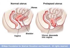 When the cervix or uterus descends into the vaginal canal.