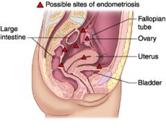 -a condition resulting from the appearance of endometrial tissue outside the uterus and causing pelvic pain.-Responds to hormone fluctuations of the menstrual cycle.
-Possible causes:
      -Retrograde menstruation, endometrail cells spread thr...