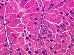 - more aggressive than normal follicular thyroid cancer
- spread by lymphatics ( as opposed to hematogenous spread)
- does not take up iodine
- Treatment - total thyroidectomy