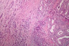 - accounts for 5% of all thyroid cancers: mostly seen in elderly patients
- highly malignant
- may arise from longstanding follicular or papillary thyroid carcinoma
- prognosis is grim- death typically occurs within a few months. Mortality is d...