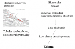 - Glomerular Injury →
- Glomerular protein leak overwhelms tubular reabsorption → 
- Loss of albumin → 
- Low plasma oncotic pressure → 
- Edema