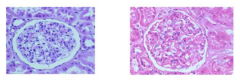 L = normal
R = membranous GN (glomerulonephritis) - capillary loops are too thick, too much pink stuff