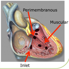 1. Perimembranous - involves membranous septum, roofed by aortic valve 
2. Muscular - surrounded by muscle
3. Inlet - bordered by the tricuspid valve. Typically part of an atrioventricular septal defect