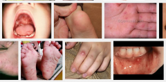 Hand, foot and mouth disease (HFMD) is a human syndrome caused by intestinal viruses of the picornaviridae family (most common viruses to cause HFMD are the coxsackie A virus and enterovirus).

HFMD usually affects infants and children, and is q...