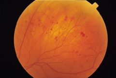 Mid-peripheral hemes, dilated (not tortuous) vessels - what is most probably diagnosis?
